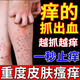 巖井昃弘皮炎濕疹皮癬真菌感染止癢膏除濕軟抑菌皮膚瘙癢身體癢止癢100%藥 3盒裝【一抹抑菌止癢】