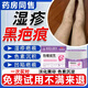 濕疹淡化黑印專(zhuān)用膏去除濕疹疤痕腿部臉脖濕疹黑印黑斑修復淡化黑印專(zhuān)用膏除兒童腿上后背痘印疤印醫用非藥膏 買(mǎi)2送1【局部黑色素沉淀】到手3盒