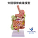 藍蝶大腸病理模型直腸腸胃病變解剖腸道疾病結腸病變人體消化系統大腸直腸十二指腸內臟腸胃構造模型 大腸帶胃病理模型