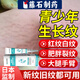藤石制藥醫用生長(cháng)紋修復霜青少年專(zhuān)用學(xué)生大腿肥胖紋淡化凝膠膏神器精華LY 買(mǎi)2送1【中重度紋路變白適用】醫用重組膠原蛋白修護