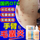 手臂毛囊炎長(cháng)痘痘胳膊上的小疙瘩 手臂毛囊炎專(zhuān)用藥毛囊堵塞手臂長(cháng)痘痘紅點(diǎn)疙瘩 克林霉素甲硝唑搽劑 1盒裝【標準裝】