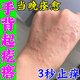 妙珍御醫(yī)堂手背癢手上長(zhǎng)小疙瘩起水泡濕疹皮膚過(guò)敏真菌感染汗?fàn)畎捳钪拱W藥膏 一盒裝