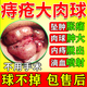 痔瘡膏去肉球內外混合痔瘡專(zhuān)用藥[視覺(jué)特效]去斷肉球神器根重度痔瘡凝膠膏庤瘡藥消腫痣熊膽痔靈膏 五盒【鞏固裝 強效 想犯都難】 肛門(mén)撕裂腸胃消化用藥