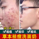 YZKMSKIN洗面奶控油祛痘除螨蟲去黑頭祛痘消炎痤瘡專用青少年成年清潔毛孔 控油祛痘洗面奶） 110ml 【單瓶裝
