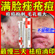 阿達帕林凝膠改得善毛孔粗大醫用祛的痘消炎痤瘡硬疙瘩專(zhuān)用藥痘痘粉刺痘印治療粉刺膿包皮膚用藥（視覺(jué)特效） 1盒裝 皮膚用藥 非處方藥
