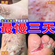 腳氣藥止癢脫皮爛腳丫真菌感染根藥治腳氣爛腳丫的藥腳爛腳趾縫癢潰爛水泡型嚴(yán)重腳氣醋酸曲安奈德益康唑乳膏 1噴劑+1乳膏【搭配效果佳【發(fā)貨特效】去藥根專用藥