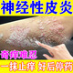 神經(jīng)性皮炎專(zhuān)用藥頑固特癥效藥皮膚瘙癢皮炎濕疹真菌感染過(guò)敏皮癬止癢100%特新期效皮膚用藥曲咪新乳膏 1盒【神經(jīng)性皮炎 皮膚紅斑瘙癢】100%止癢