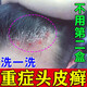 喬記本草頭皮癬銀屑病洗發(fā)水牛皮癬專(zhuān)用洗發(fā)水非藥頭屑頭癢頭皮癬真菌感染 三盒裝（多人選擇）買(mǎi)2送1 頭皮癬