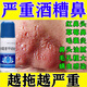 酒糟鼻專用藥治療想修復(fù)紅鼻子槽玫瑰痤瘡鼻翼兩頰發(fā)紅毛孔粗大炎性丘疹凹凸不平鼻子油膩克林霉素甲硝唑搽劑 1盒裝【鼻子泛紅脫皮】