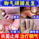 治腳氣藥止癢脫皮爛腳丫真菌感染QK腳根干裂開裂水泡型腳氣糜爛腳趾縫癢發(fā)白嚴(yán)重腳臭腳癢香港腳克霉唑乳膏 1乳膏+1噴霧【搭配使用·嚴(yán)重腳氣】熱銷推薦