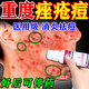 克林霉素甲硝唑搽劑祛痘消炎治痤瘡去青春痘粉刺硬疙瘩膿包修復(fù)痘印青少年皮膚專用藥可搭配藥膏【視覺特效】 2盒【建議療程裝】
