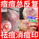 丹參酮膠囊祛痘消炎痤瘡專用藥青少年學(xué)生男女去痘痘和痘印抗菌消炎背上長痘痘藥毛囊炎青春痘紅腫粉刺膿包癤 1盒裝【痤瘡痘痘】
