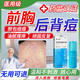 前胸后背長痘痘膿包痤瘡皮膚瘙癢背后上毛囊炎專用膏后背祛痘止癢紅腫手臂紅疙瘩Q2 一盒  【胸背部毛囊炎】