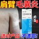 優(yōu)立特手臂毛囊炎專用噴劑肩膀長痘痘紅斑膿包胳膊上的小疙瘩丘疹疤痕N3 一盒裝【手臂毛囊炎丘疹皮膚粗糙】