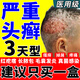 正品頭皮癬頭癢頭皮屑多治療洗發(fā)水毛囊炎頭部專用藥頭上長紅疙瘩膿包紅腫痘痘脂溢性皮炎真菌感染克霉唑乳膏 2盒醫(yī)用皮膚用藥頭蘚專用藥頭上有疙瘩瘙癢發(fā)貨特效快