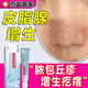 皮脂腺增生專(zhuān)用膏面部囊腫凸起疙瘩黃色丘疹膏皮膚凹陷可搭專(zhuān)用皮膚增生藥去除藥膏MT 1盒【皮脂腺增生專(zhuān)用膏】