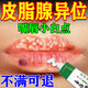 皮脂腺異位癥去除嘴唇長白點脂肪小顆粒專用嘴角增生口角炎唇膏 單盒體驗裝