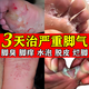 腳氣藥止癢脫皮爛腳丫去真菌感染根藥治止癢脫皮爛腳起小水泡腳爛腳趾縫癢潰爛專(zhuān)用藥硝酸咪康唑乳膏視覺(jué)特效 1盒裝【國藥OTC正品】建議多盒