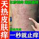 熱癢止癢膏抑菌皮膚瘙癢身體癢止癢特專效藥皮膚瘙癢皮炎濕疹真菌感染止癢藥膏天熱疙瘩復(fù)方倍氯米松樟腦乳膏 1盒【身上癢起紅疙瘩長紅點(diǎn)】早用早舒服