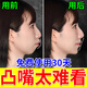 巴貝奇  BABBAGE嘴凸否矯正器下巴后縮大人兒童骨性牙齒錯位不齊齙牙地包天牽引器 第一階段偏軟佩戴1-2個月