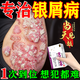 百癬夏塔熱片京大東大藥房 治銀屑病藥[進(jìn)口服用 視覺(jué)特效]牛皮癬專(zhuān)用藥銀屑病皮膚癬止癢抑菌皮膚瘙癢身體癢 5盒【療程裝】輕松治療不復購 【皮膚用藥 非處方藥】