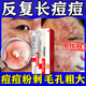 阿達帕林凝膠改得善毛孔粗大醫用祛的痘消炎痤瘡硬疙瘩專(zhuān)用藥痘痘粉刺痘印治療粉刺膿包皮膚用藥（視覺(jué)特效） 1盒裝【皮膚用藥 非處方藥】