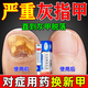 灰指甲專(zhuān)用藥 指甲真菌感染增厚發(fā)黃變厚變空根部治嚴重灰指甲指甲脫甲壞甲增厚皮膚用藥 環(huán)吡酮胺乳膏 1盒【灰指甲專(zhuān)用藥】國藥OTC