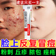阿達帕林凝膠醫(yī)用袪痘消炎痤瘡專用青少年 痘痘藥膏治療座瘡臉上長痘痘的藥 痤瘡膏 膿皰瘡小顆粒皮膚用藥 1盒