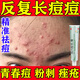 維a酸乳膏 祛痘藥膏祛痘消炎痤瘡專用青春痘祛痘膏臉上額頭長痘痘的藥淋巴痘腮邊痘粉刺祛痘印醫(yī)用皮膚用藥 1盒【臉上爆痘 一碰就疼】祛痘專用