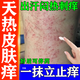 熱癢止癢膏抑菌皮膚瘙癢身體癢止癢皮膚瘙癢皮炎濕疹真菌感染止癢藥膏天熱疙瘩復(fù)方倍氯米松樟腦乳膏 1盒【身上癢起紅疙瘩長紅點】早用早舒服
