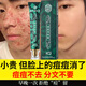 南京同仁堂祛痘膏去痘痘和痘印痘坑修復(fù)男女士改善粉刺閉口30g