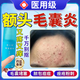 代文兒童額頭上長(cháng)小粒痘痘面部毛囊炎毛孔堵塞頭皮上長(cháng)痘臉頰痘痘CN 藥監備案【一盒裝】額頭痘痘毛囊炎