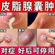皮脂腺囊腫專用藥拔毒藥膏火癤子膿包疙瘩皮脂腺囊腫臉上硬疙瘩痘痘火癤子硬塊消瘡癤膏皮膚用藥莫匹羅星軟膏 1盒【皮脂腺囊腫專用藥膏】