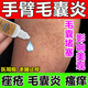 克林霉素甲硝唑搽劑 手臂毛囊炎專用特癢效藥 手臂毛囊炎長痘痘胳膊上的小疙瘩有黑點(diǎn)堵塞藥皮膚用藥 3盒裝【手臂毛囊炎】亦可用于全身