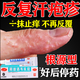 手上癢起泡專用真菌感染濕疹止癢汗皰疹專用藥濕疹特正效藥止癢去病根手氣真菌感染特正效藥阿昔洛韋乳膏 1盒片【手指小水泡】一抹看效