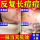 祛痘藥膏阿達(dá)帕林凝膠祛痘印修復(fù)淡化痘印痘坑修復(fù)藥膏醫(yī)用 祛痘消炎痤瘡專用 青春痘祛痘藥膏學(xué)生去痘痘 1盒阿昔洛韋祛痘祛痤瘡】各處漲痘痘藥膏