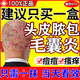 正品頭皮癬頭癢頭皮屑多治療洗發(fā)水毛囊炎頭部專用藥頭上長紅疙瘩膿包紅腫痘痘脂溢性皮炎真菌感染克霉唑乳膏 1支醫(yī)用皮膚用藥頭蘚專用藥頭上有疙瘩瘙癢發(fā)貨特效快