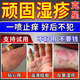內(nèi)廷上用皮膚瘙癢皮炎頑固性濕疹真菌感染止癢抑菌膏藥十大牌子去草根噴劑 白色【一盒裝】止癢抑菌 濕疹噴劑膏抑菌止癢身體癢真菌王