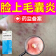 毛囊炎臉部噴劑可搭專(zhuān)用膏有藥監備案面部臉上長(cháng)瘩疙膿包痘痘用什么的藥膏去除紅疙瘩痤瘡脂溢性皮炎N3 送棉簽【一盒裝】體驗裝