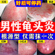 克霉唑乳膏陰部瘙癢私處止癢軟膏男士龜頭炎專用藥真菌感染 念珠菌 霉菌包皮炎止癢殺菌皮膚用藥克酶銼乳膏 一盒【龜頭炎專用藥真菌感染】