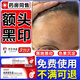 額頭黑色素沉淀去除淡化臉上面部嘴角黑斑點(diǎn)祛痘印疤痕印去斑搭專用黑斑去除凝膠CB 1盒【體驗(yàn)裝】額頭黑色素專用凝膠