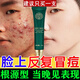 同仁堂草本祛痘膏痘印痘疤痘坑青春痘閉口粉刺男女學生20g