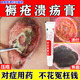 褥瘡特治療效藥褥瘡膏傷口愈合去腐生新肌褥瘡藥老人臀部外用褥瘡潰爛抑菌壓瘡特新期效藥防褥瘡紅霉素軟膏 一盒【皮膚破損潰爛 紅斑化膿】主圖視覺(jué)特效