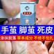 DAGO清繭靈繭立凈去老繭子手腳厚去腳底老繭去硬皮官方軟化劑腳部手繭