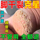 明威中草堂腳裂膏腳后跟干裂開(kāi)裂真菌感染專(zhuān)用秋冬手足干燥脫皮皸裂龜裂藥膏 拍1發(fā)3【強(qiáng)效修護(hù)/修復(fù)裂口】