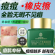 同仁堂祛痘膏痘疤淡化痘坑修復(fù)呵護痘肌痘印亮膚去粉刺青春痘20g