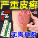 華佗膏治牛皮癬銀屑病專(zhuān)用藥頑固牛皮癬銀屑病去真菌止癢抑菌皮膚藥膏皮膚瘙癢身體癢華佗膏皮膚用藥【視覺(jué)特效】 5盒療程裝【輕松治療反復牛皮癬】