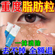 肪粒去除藥膏 去汗管瘤脂肪粒專(zhuān)用藥脂肪油脂粒粟丘疹脂肪粒去除神器眼周專(zhuān)用去小顆粒 維A酸乳膏 1盒【消除汗管瘤】