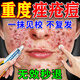北京同仁堂祛痘消炎痤瘡專用青少年乳膏藥青春痘粉刺硬疙瘩修復(fù)消炎去除痘印 特價:拍一發(fā)三盒【僅一天】(發(fā)貨特效快)