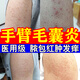 手臂毛囊炎長痘痘胳膊上的小疙瘩手臂毛囊炎專用 毛囊炎專用（發(fā)貨特效率）藥 克林霉素甲硝唑搽劑 1盒裝【手臂毛囊炎】